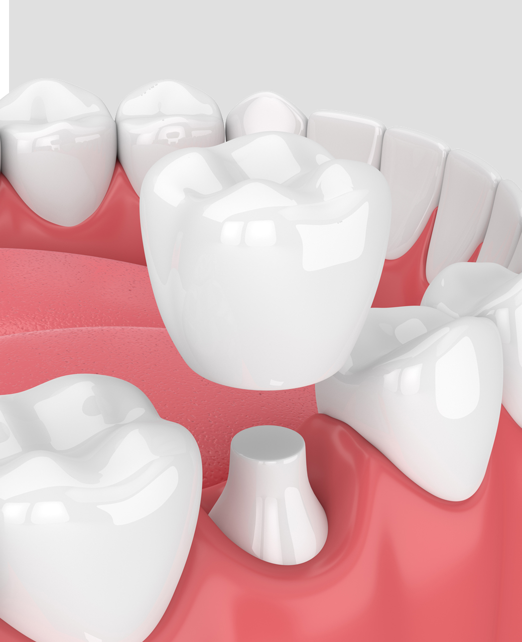 dental-crown