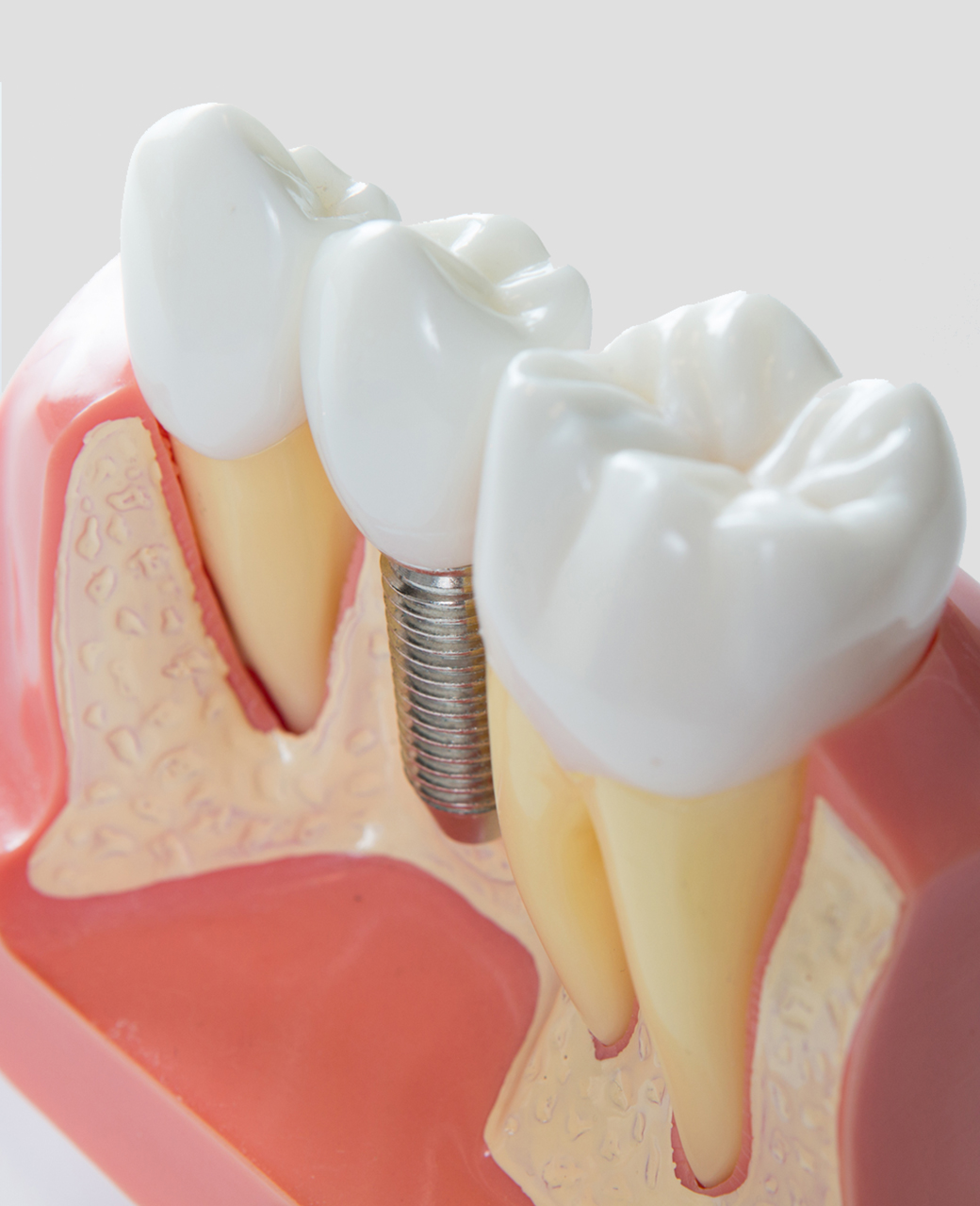 dental-implants