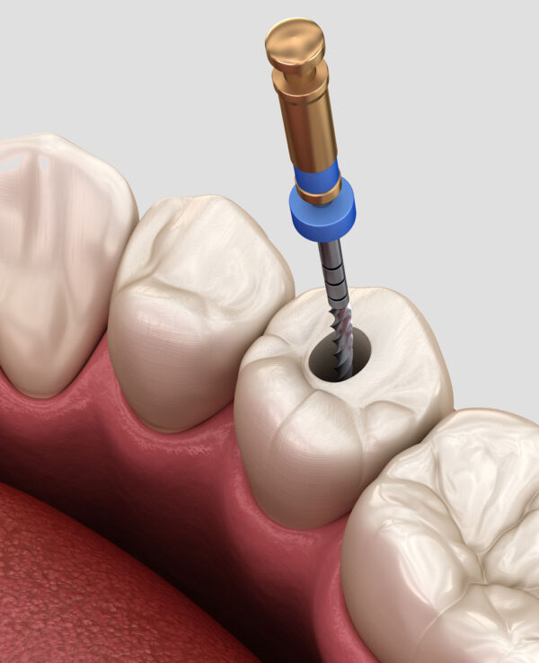 Root Canal Retreatment Calgary Chinook Dental Group