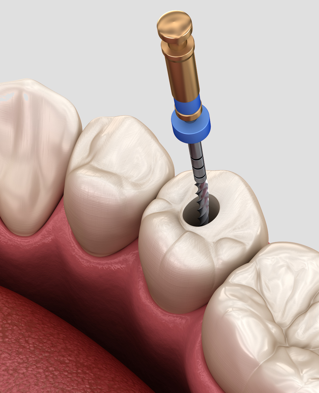 endodontic-retreatment