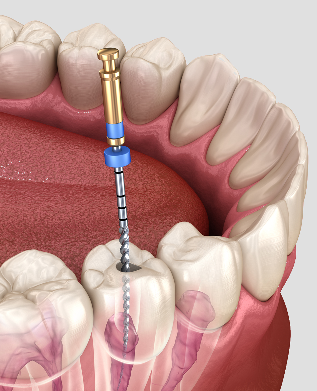 endodontist-root-canal