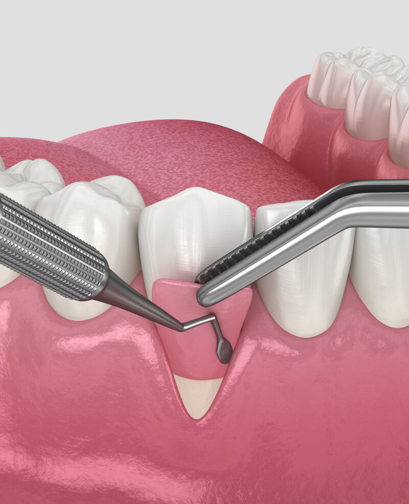 Gum Grafts Calgary | Chinook Dental Group