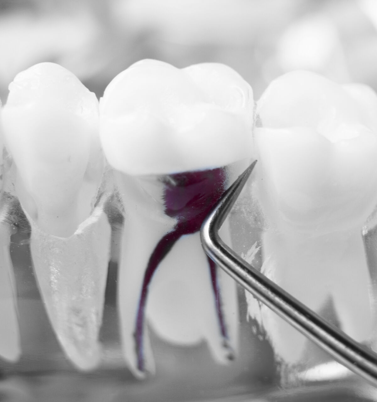 Endodontic Microsurgeries Calgary Chinook Dental Group