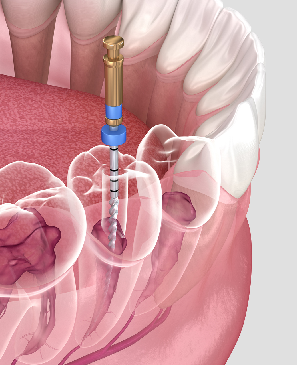 root-canal-microsurgery