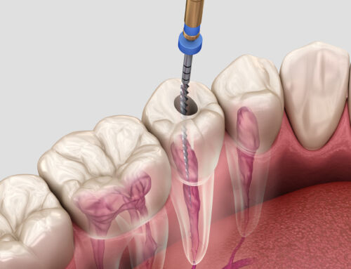Does a root canal hurt?