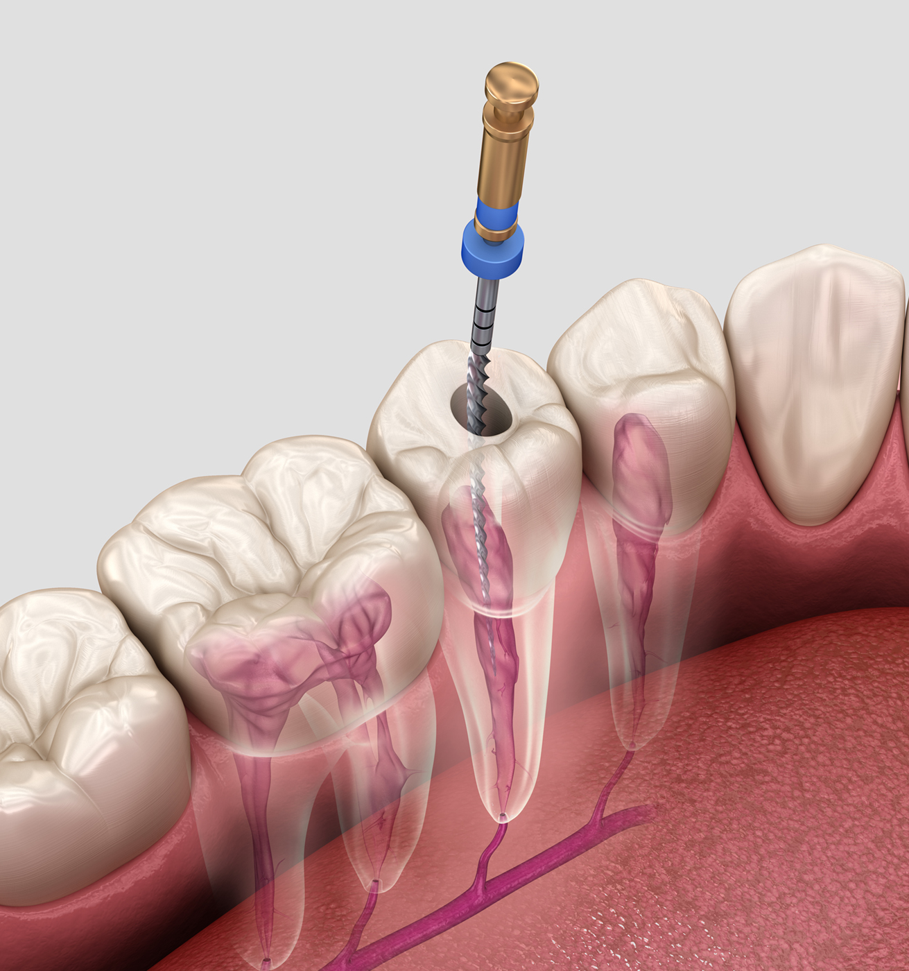 root-canal-process