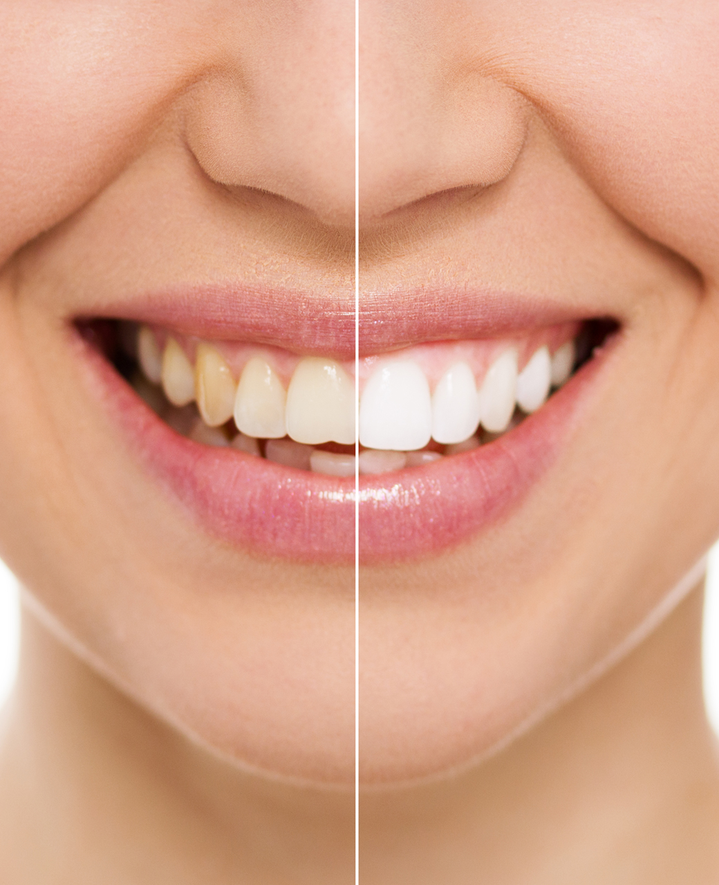 zoom-teeth-whitening