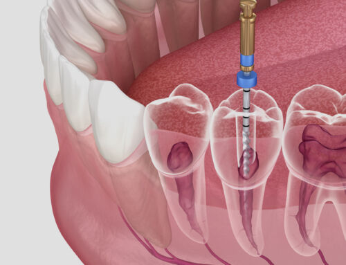 What is a Root Canal?