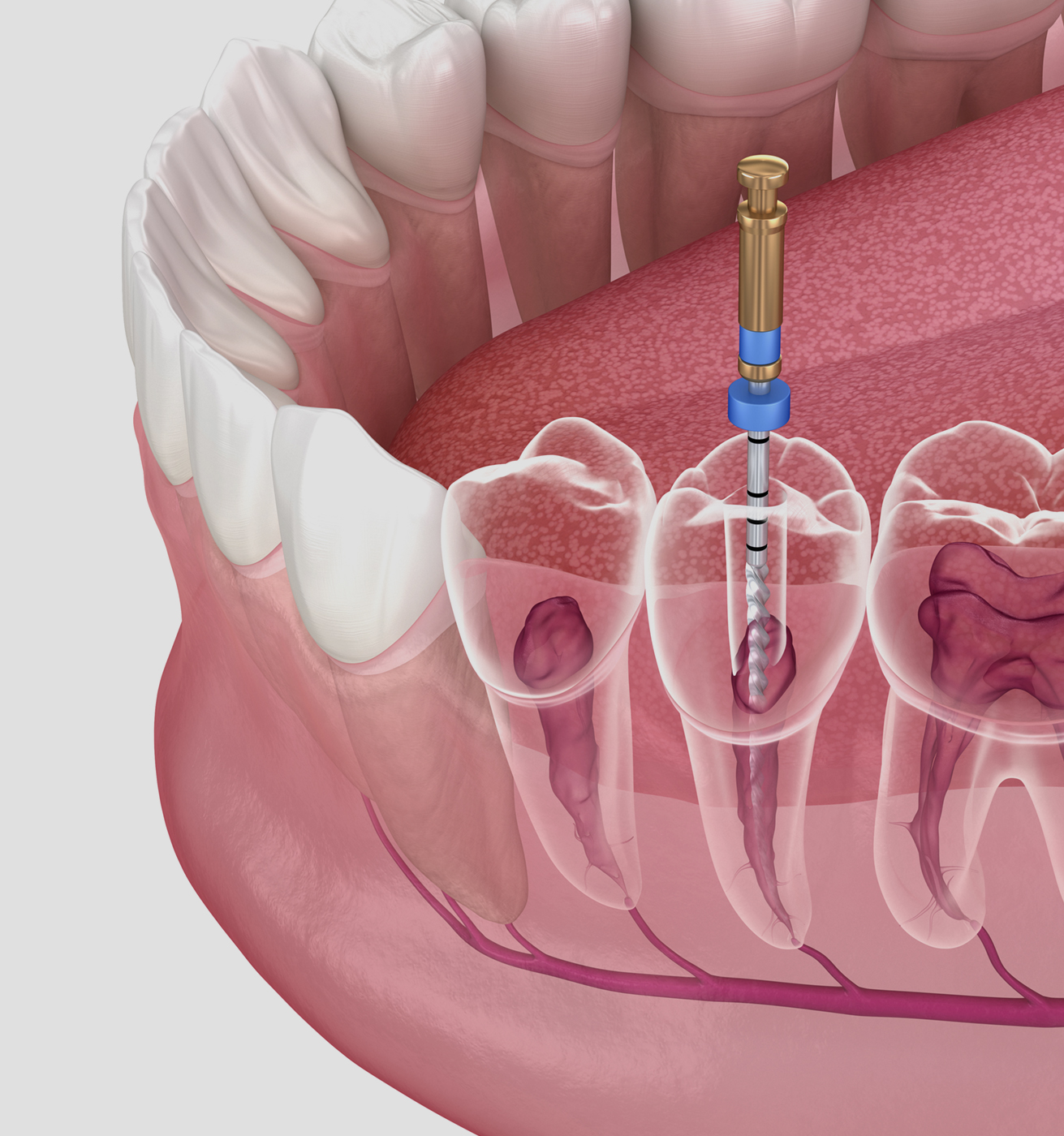 What is a root canal?