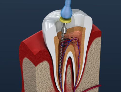 Symptoms of a Root Canal Infection
