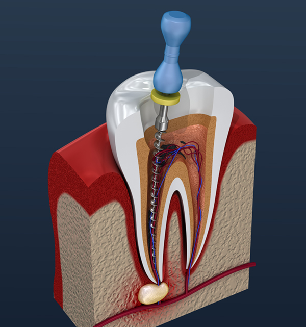 Symptoms of a Root Canal Infection