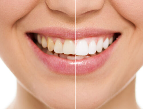 Dental Restoration: What is it?