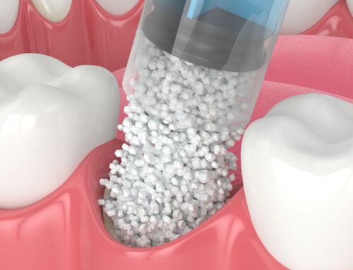 What are Dental Bone Grafts? Benefits, Procedure, Results