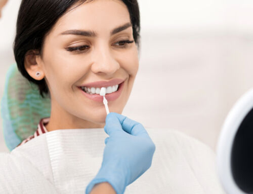 Dental Veneers: Benefits, Procedure, Results