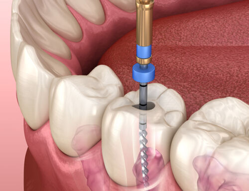 Cost of a Root Canal in Canada