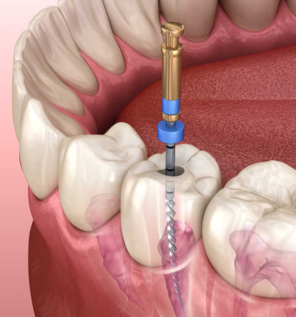 Cost of a Root Canal in Canada