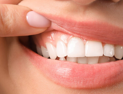 Gingivitis: What Your Gums Are Telling You