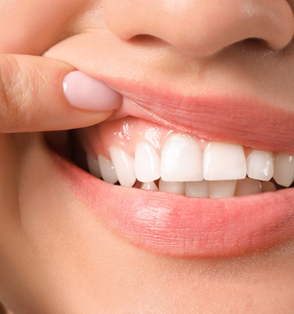 Gingivitis: What Your Gums Are Telling You