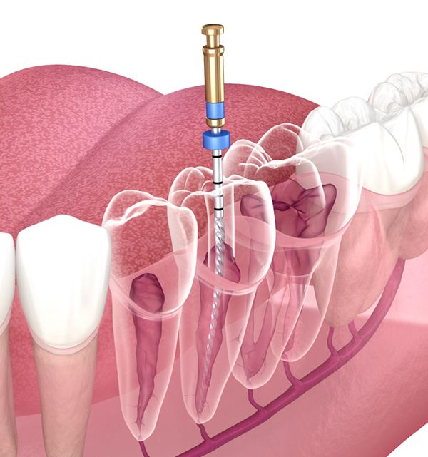 Tooth Repair Anatomical Chart -  Canada