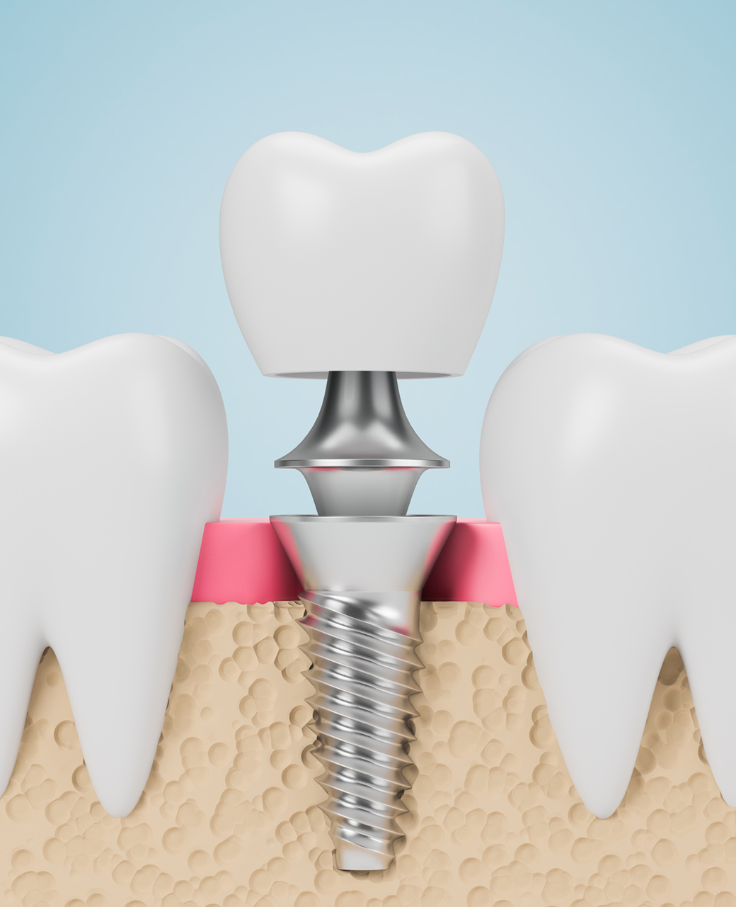 dental-implants-calgary