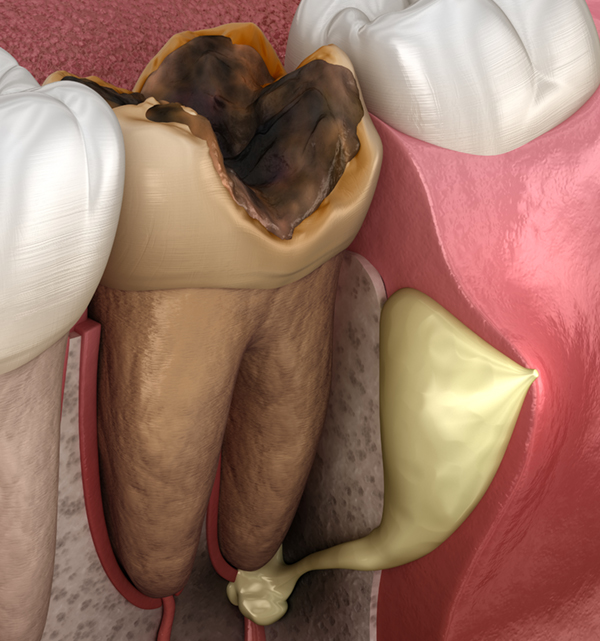 Tooth Abscess