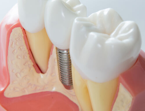 What is the Difference Between a Full Dental Crown and a Partial Crown?