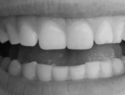Pale Gums: Understanding the Causes and Remedies
