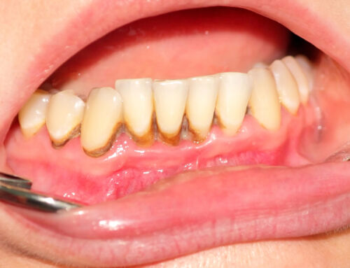 Periodontal Scaling and Root Planing