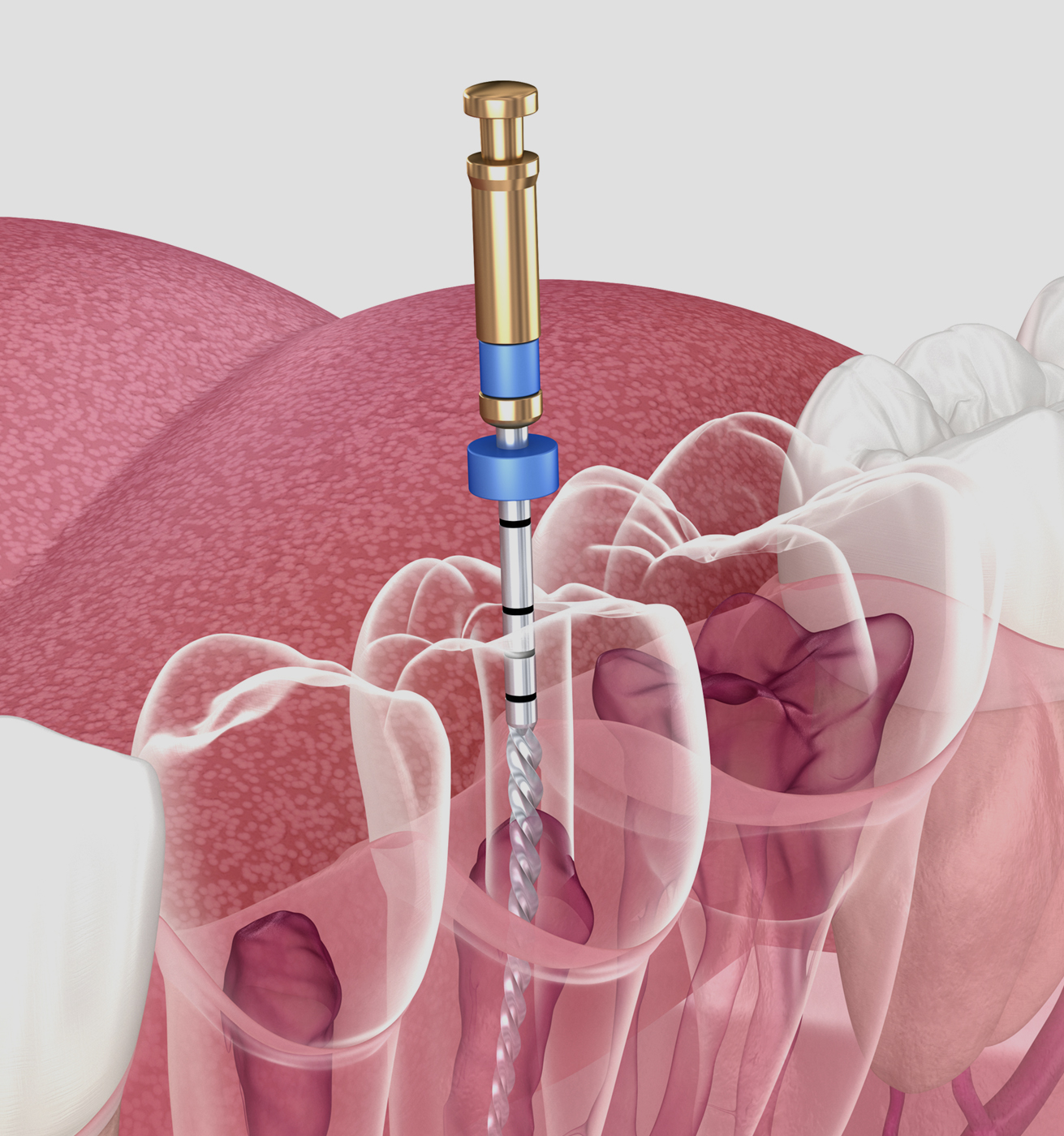 root-canal-process