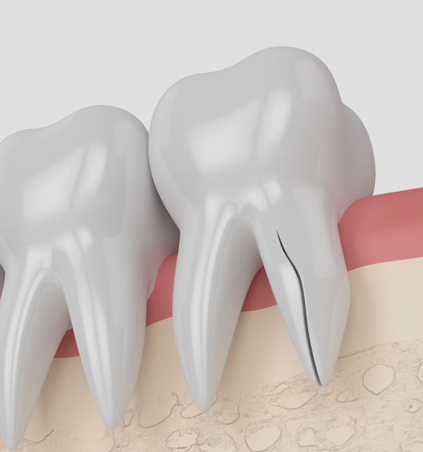 types of cracked teeth